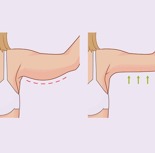 Brachioplastie reduction exces peau Tours