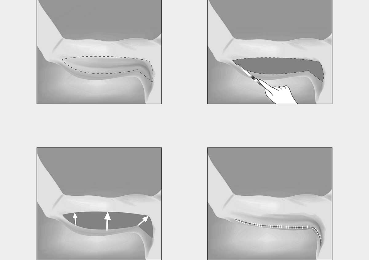 Procedure Brachioplastie Tours