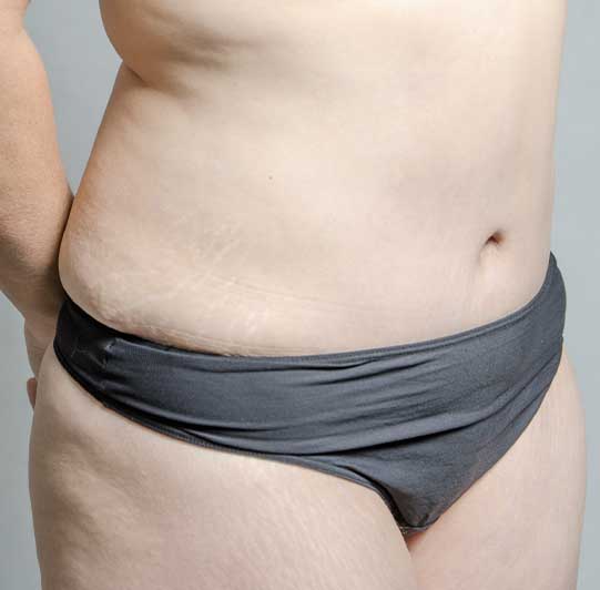 Abdominoplastie Apres