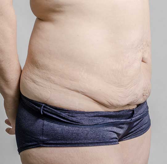 Abdominoplastie Avant