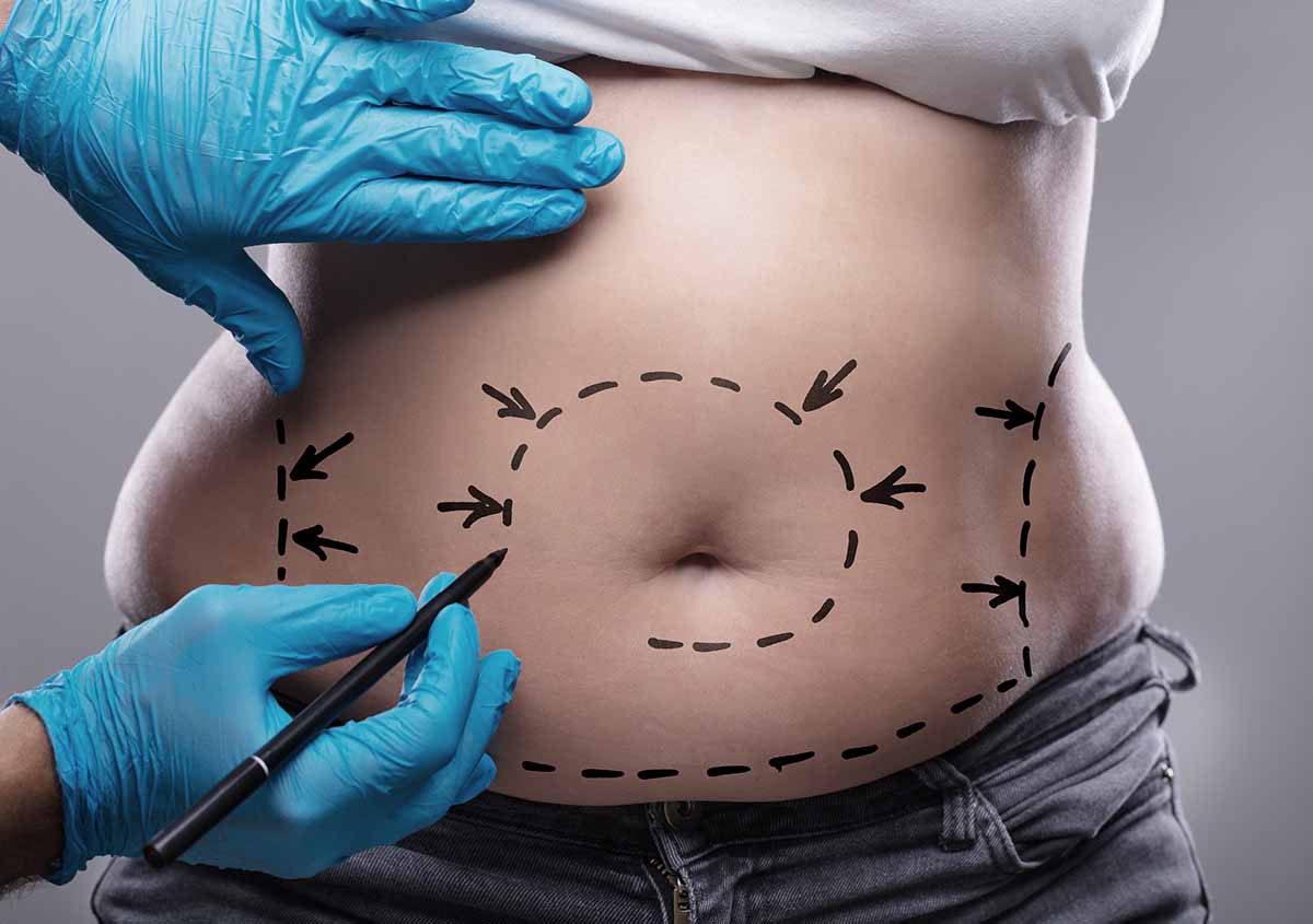 Abdominoplastie Tours