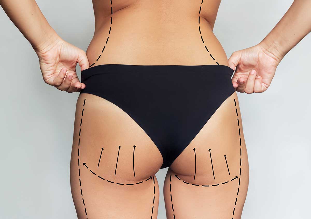 Bodylift chirurgie reconstructrice Tours