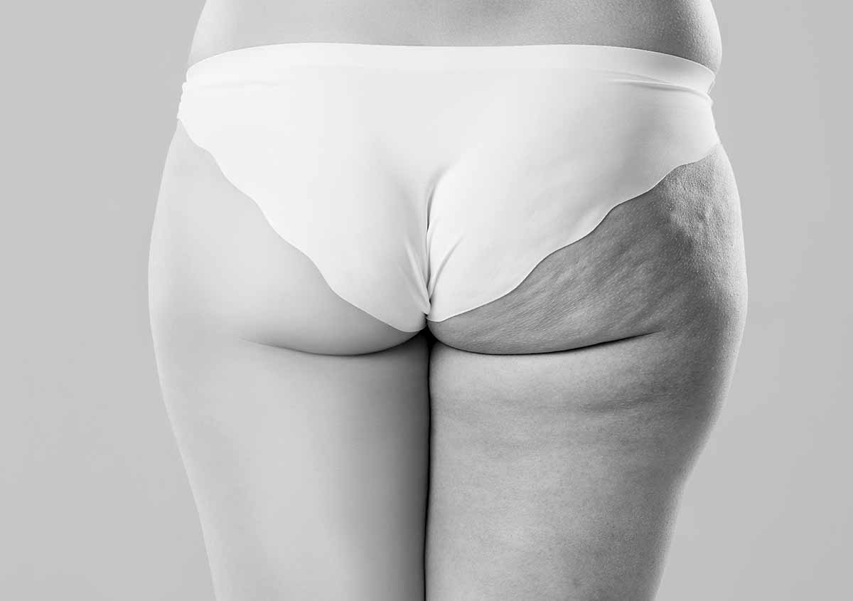 Culotte de cheval liposuccion, Tours