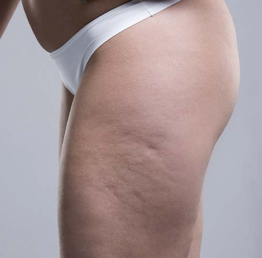 Lipoaspiration, cuisse, Tours