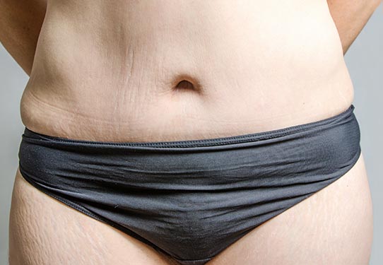 Abdominoplastie Avant Après Tours