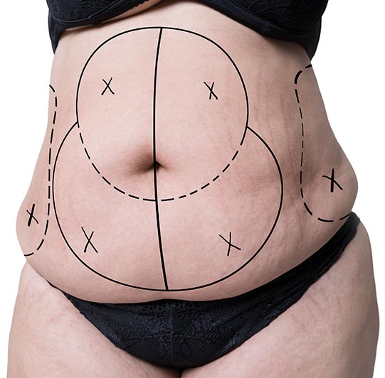 Abdominoplastie repérage Tours