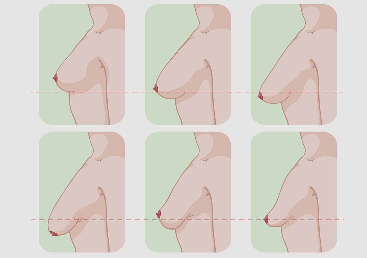 Différentes formes de Ptoses mammaires