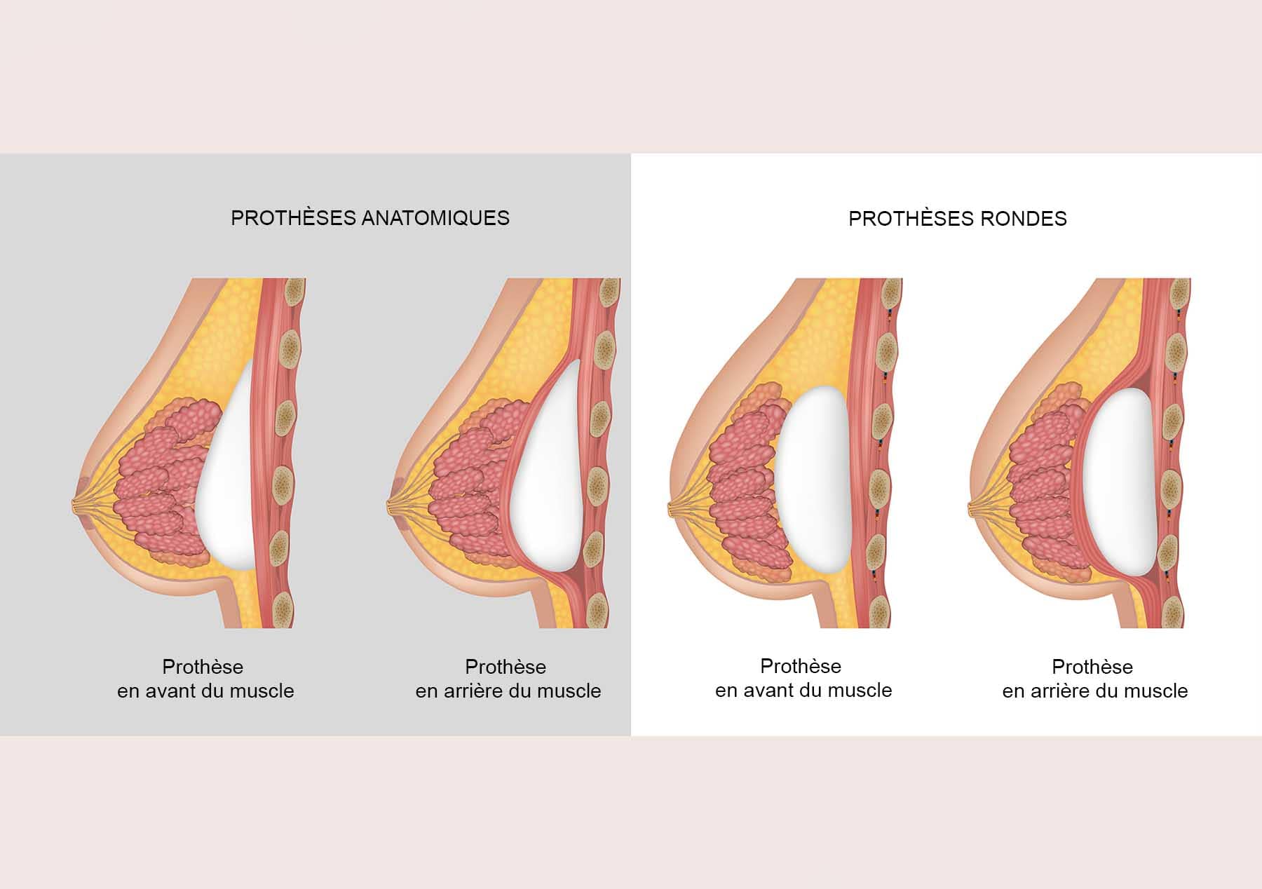 Prothèses implants mammaires Tours