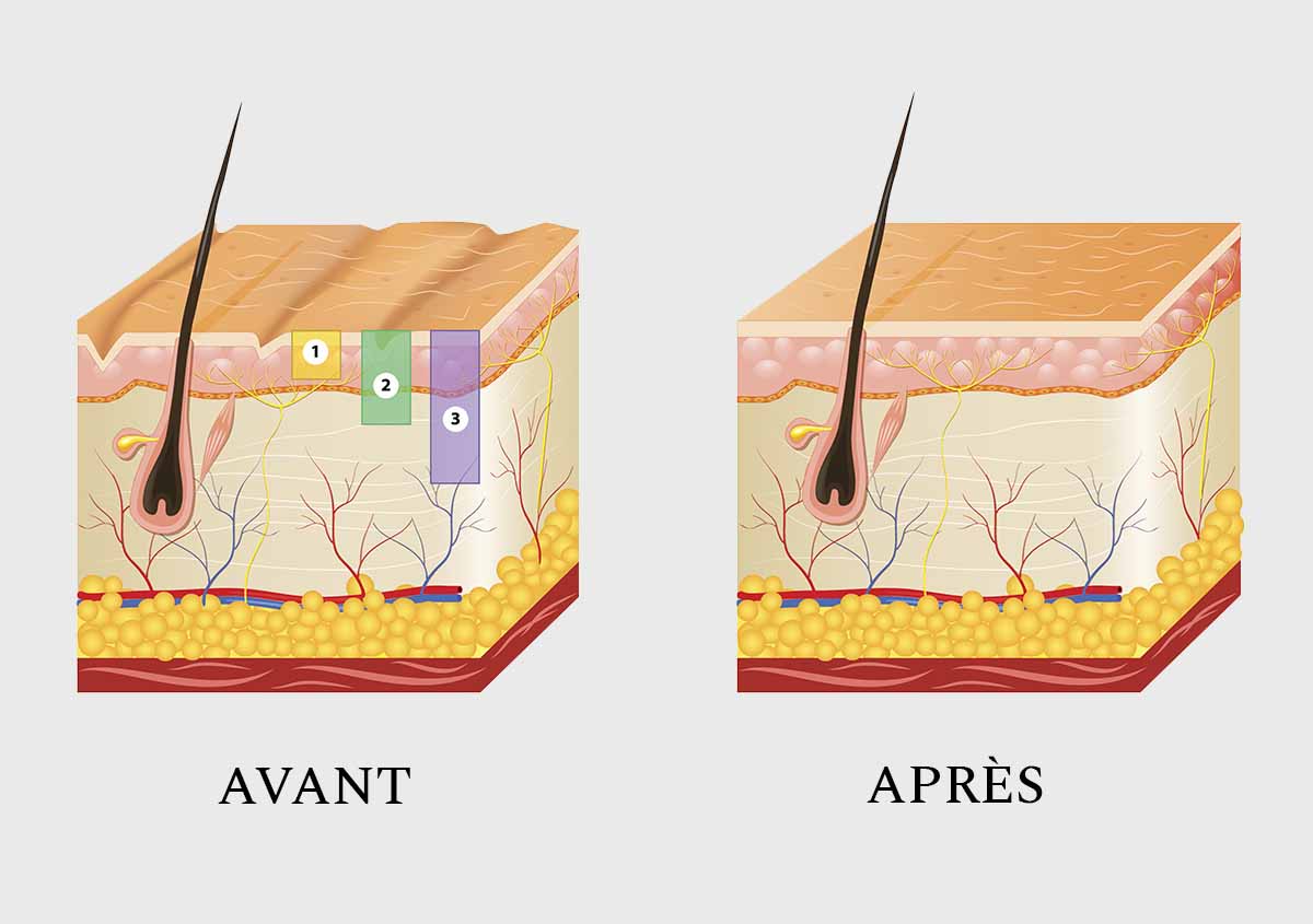 PEELING DU VISAGE